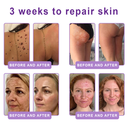 FDA Official: HISKIN® PDRN Multi-Peptide Massaging Body Roller Cream- Anti-aging, Hydrating, Skin Firming & Lifting, Skin Repair, Even Tone, Acne and Dark Spot Treatment, Wart and Mole Removal, and Psoriasis Relief.