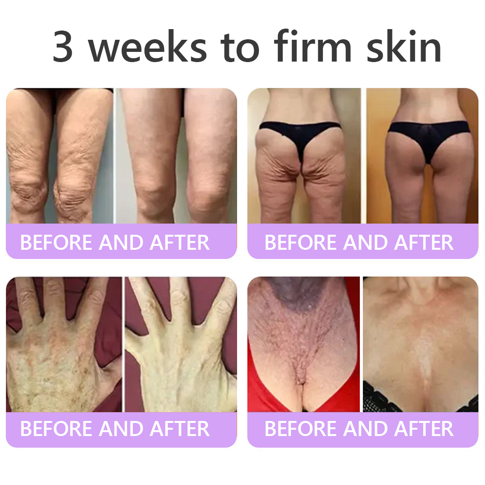 FDA Official: HISKIN® PDRN Multi-Peptide Massaging Body Roller Cream- Anti-aging, Hydrating, Skin Firming & Lifting, Skin Repair, Even Tone, Acne and Dark Spot Treatment, Wart and Mole Removal, and Psoriasis Relief.
